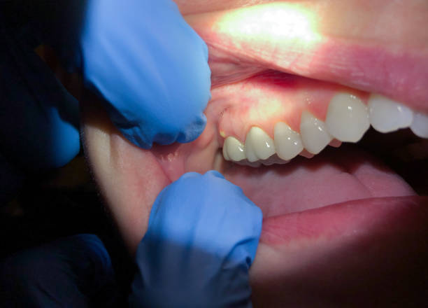 Best Emergency Denture Repair in Phillipsburg, NJ